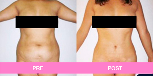 abdominoplastia antes y despues