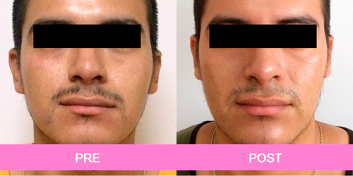 lipoescultura facial antes y despues