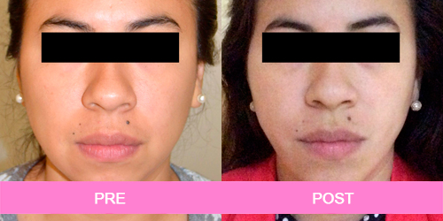 lipoescultura facial antes y despues