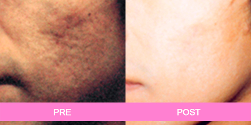 acne antes y despues